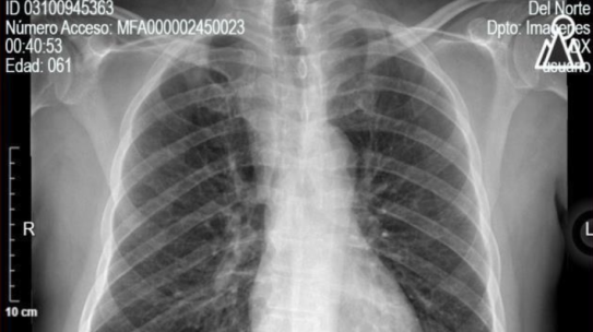 CETOACIDOSIS DIABÉTICA EUGLUCÉMICA: A PROPÓSITO DE UN CASO
